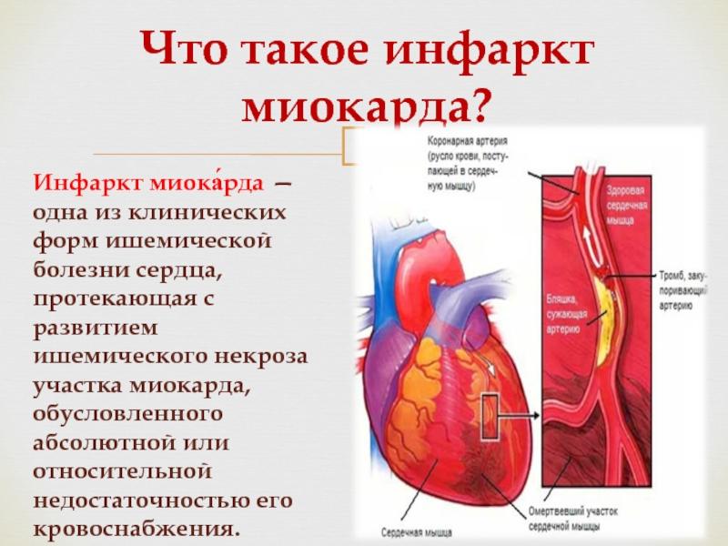 Лечение инфаркта миокарда. Инфаркт миокарда презентация. Презентация по теме инфаркт миокарда. Современное лечение инфаркта миокарда.