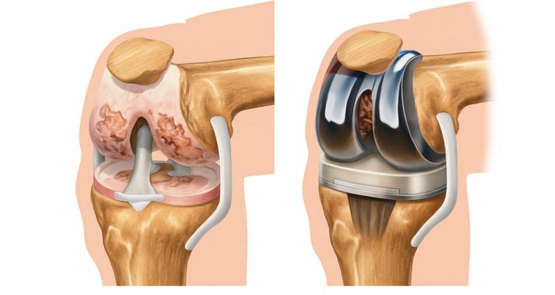 Эндопротезирование коленного сустава: показания, выбор специалиста и ход операции
